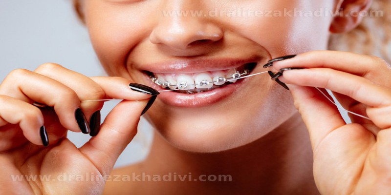 نحوه کشیدن نخ دندان حین ارتودنسی چگونه است؟